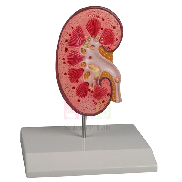 Kidney Stone Model